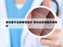 廊坊看牛皮癣哪家最好 廊坊皮肤病医院哪家好