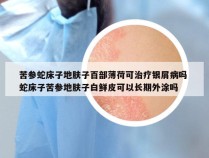 苦参蛇床子地肤子百部薄荷可治疗银屑病吗 蛇床子苦参地肤子白鲜皮可以长期外涂吗