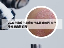 2020年治疗牛皮癣有什么最好的药 治疗牛皮癣最新的药