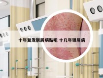 十年复发银屑病贴吧 十几年银屑病