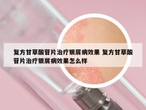复方甘草酸苷片治疗银屑病效果 复方甘草酸苷片治疗银屑病效果怎么样