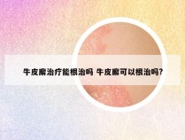 牛皮廨治疗能根治吗 牛皮廨可以根治吗?