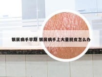 银屑病手早期 银屑病手上大量脱皮怎么办