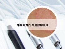 牛皮癣刀口 牛皮肤癣手术