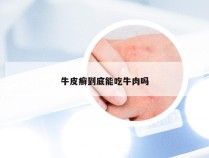 牛皮癣到底能吃牛肉吗