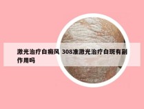 激光治疗白癜风 308准激光治疗白斑有副作用吗