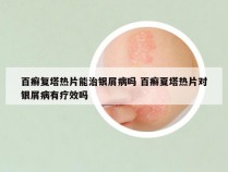 百癣复塔热片能治银屑病吗 百癣夏塔热片对银屑病有疗效吗