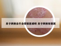 鼻子两侧会不会得银屑病呀 鼻子两侧有银屑
