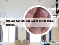 银屑病用白面和麸子能治病吗 面部银屑病能敷面膜吗