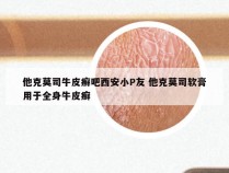 他克莫司牛皮癣吧西安小P友 他克莫司软膏用于全身牛皮癣