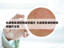 头部银屑病初期症状图片 头部银屑病初期症状图片女性