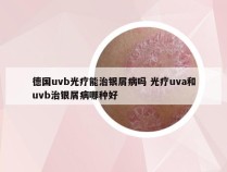 德国uvb光疗能治银屑病吗 光疗uva和uvb治银屑病哪种好