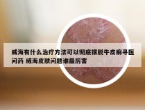 威海有什么治疗方法可以彻底摆脱牛皮癣寻医问药 威海皮肤问题谁最厉害