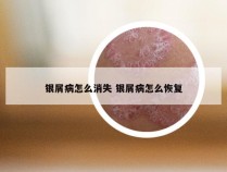 银屑病怎么消失 银屑病怎么恢复