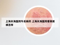 上海长海医院牛皮癣药 上海长海医院看银屑病怎样