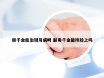 肤千金能治银屑病吗 肤毒千金能擦脸上吗