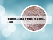 银屑病跟scc升高有关联吗 银屑病与scc增高