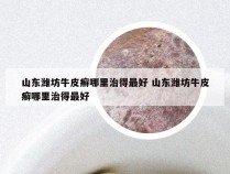 山东潍坊牛皮癣哪里治得最好 山东潍坊牛皮癣哪里治得最好