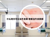 什么地方可以治牛皮癣 哪里治牛皮肤癣