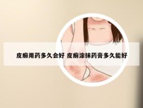 皮癣用药多久会好 皮癣涂抹药膏多久能好