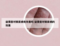 益赛普对银屑病有效果吗 益赛普对银屑病的效果