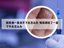 银屑病一直消不下去怎么办 银屑病犯了一直下不去怎么办