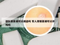 部队银屑病可以病退吗 军人得银屑病可以评残吗