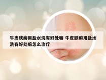 牛皮肤癣用盐水洗有好处嘛 牛皮肤癣用盐水洗有好处嘛怎么治疗
