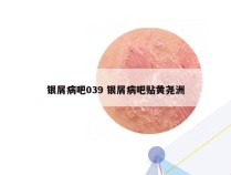 银屑病吧039 银屑病吧贴黄尧洲
