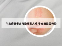 牛皮癣患者会传染给家人吗 牛皮癣能否传染
