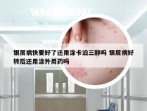 银屑病快要好了还用涂卡泊三醇吗 银屑病好转后还用涂外用药吗