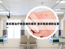 重庆那治疗银屑病效果好 重庆银屑病排名第一