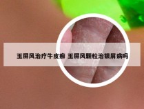 玉屏风治疗牛皮癣 玉屏风颗粒治银屑病吗