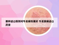 那种进口擦剂对牛皮癣效果好 牛皮肤癣进口药膏