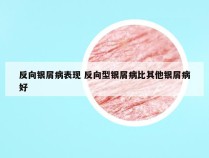 反向银屑病表现 反向型银屑病比其他银屑病好