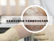 牛皮癣可以擦大蒜 牛皮肤癣可以吃大蒜吗