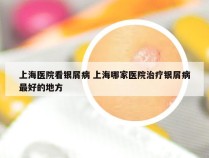 上海医院看银屑病 上海哪家医院治疗银屑病最好的地方
