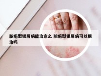 脓疱型银屑病能治愈么 脓疱型银屑病可以根治吗