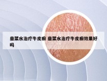 韭菜水治疗牛皮癣 韭菜水治疗牛皮癣效果好吗