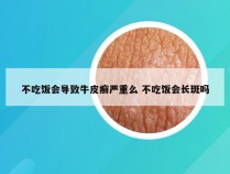 不吃饭会导致牛皮癣严重么 不吃饭会长斑吗