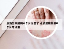 点滴型银屑病六个月治愈了 点滴型银屑病6个月才消退