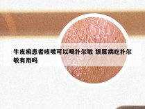 牛皮癣患者咳嗽可以喝扑尔敏 银屑病吃扑尔敏有用吗