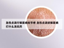 急性点滴行银屑病关节疼 急性点滴状银屑病打什么消炎药