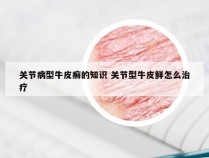 关节病型牛皮癣的知识 关节型牛皮鲜怎么治疗