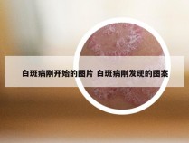 白斑病刚开始的图片 白斑病刚发现的图案