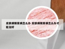 皮肤病银屑病怎么办 皮肤病银屑病怎么办才能治好