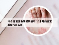 16个月宝宝会生银屑病吗 16个月的宝宝有脚气怎么办