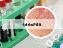 牛皮癣的好转期