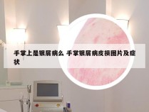 手掌上是银屑病么 手掌银屑病皮损图片及症状