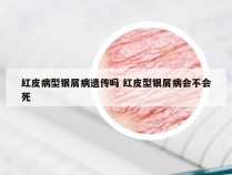 红皮病型银屑病遗传吗 红皮型银屑病会不会死